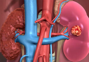 Kidney disease