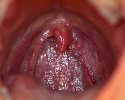 Throat cancer