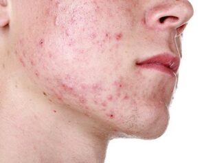Tips To Prevent Acne