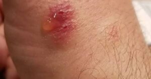 How Do Spider Bite Look Like