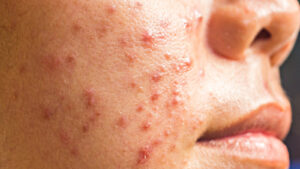 Tips To Prevent Acne